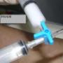 TRATAMIENTO DE VARICES CON ESPUMA