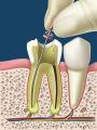Endodoncia