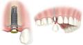 Implantes y Cirugía