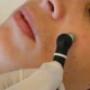 Radiofrecuencia Facial - Peeling