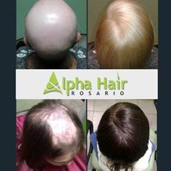 Alpha Hair Rosario Implante Capilar Sin Cirugia