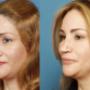 Botox