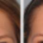 Botox