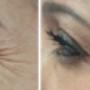 Botox