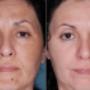 Melasma y Cloasma. ( manchas en la piel) Peelings.