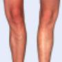Varices en hombres