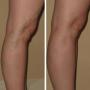 Varices tronculares