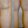 Varices tronculares
