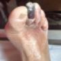 Subido por visitante en 20/6/2016 - Segundo dedo necrosado, mala praxis. pacientes sin pulso presente.