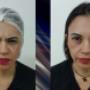 Botox de cara