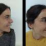 Botox rostro