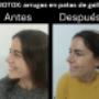 TOXINA BOTULINICA ROSTRO
