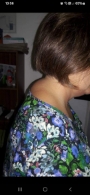 Antes de sesión de Corrección de giba cervical
